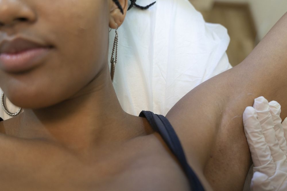 Sugaring: Skånsom hårfjerning med langvarig resultat