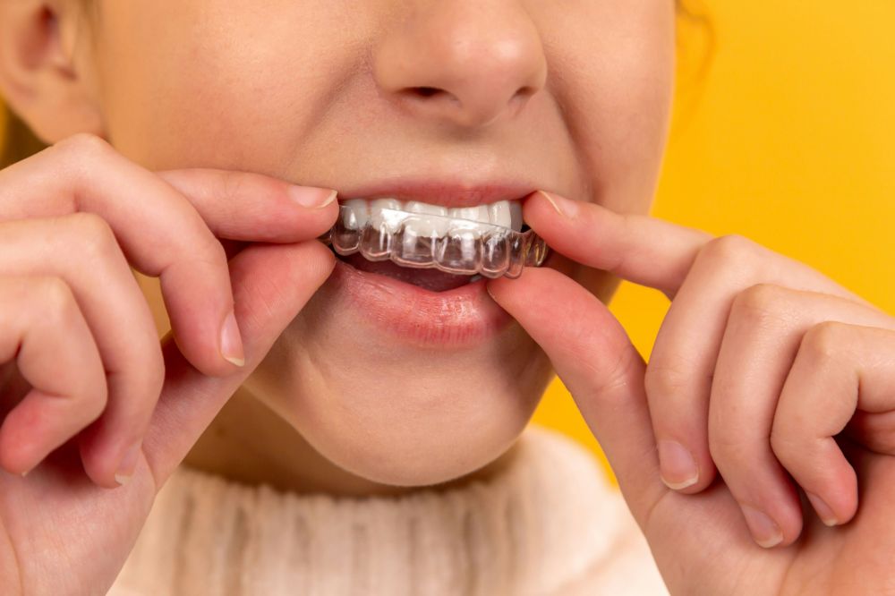 Invisalign  moderne tannregulering uten synlige klosser